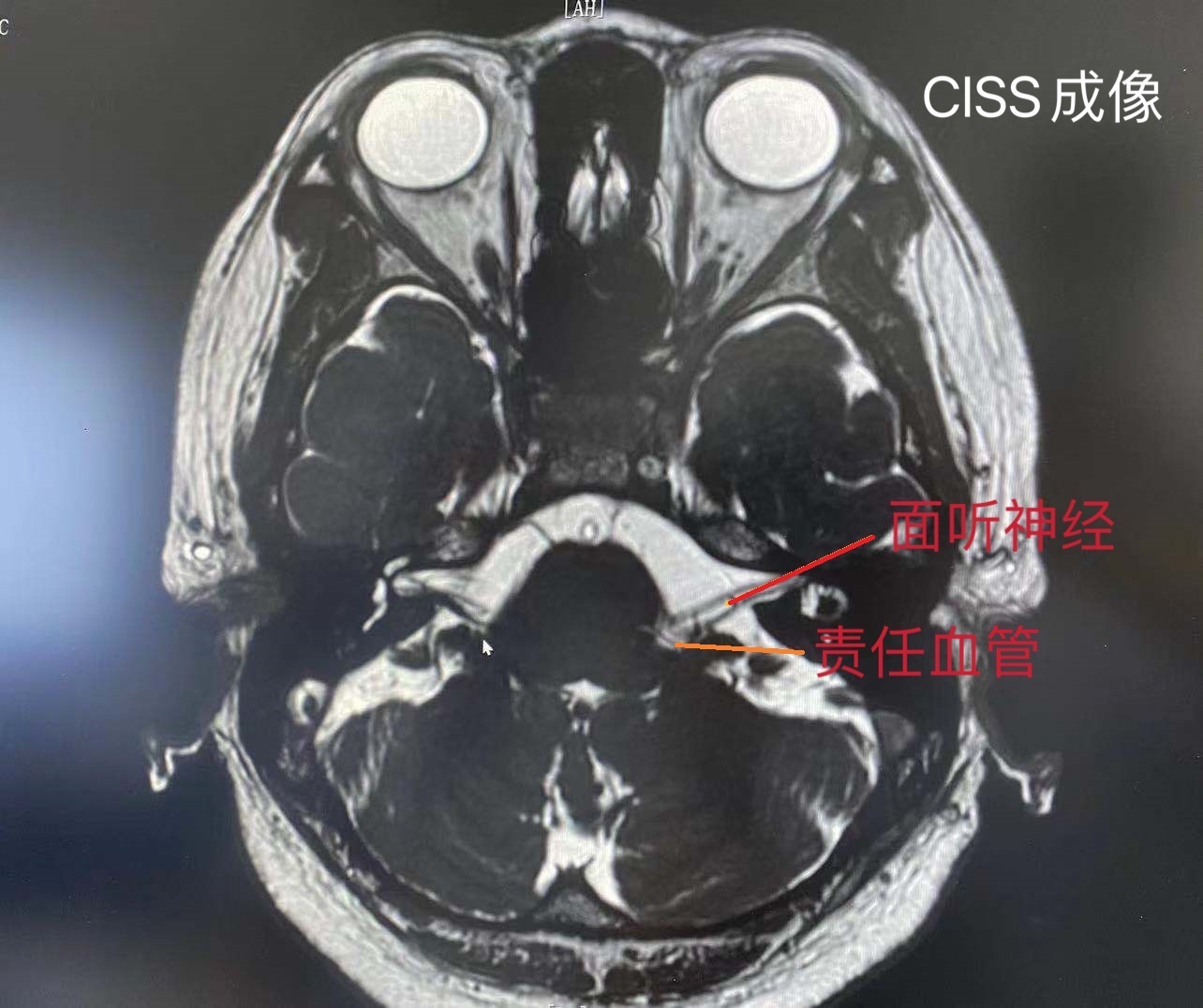 华安脑科医院成功开展首例面肌痉挛显微血管减压术 华安脑科医院成功开展首例面肌痉挛显微血管减压术