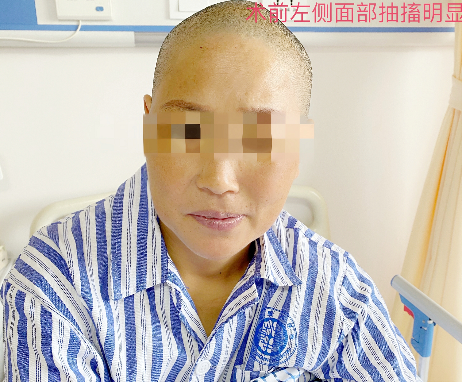 华安脑科医院成功开展首例面肌痉挛显微血管减压术 华安脑科医院成功开展首例面肌痉挛显微血管减压术
